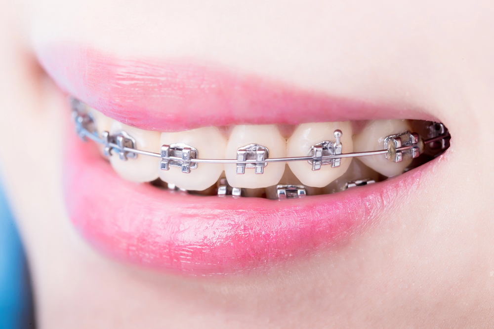 Braces
